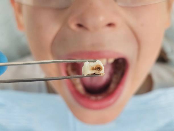 Best Root Canal Emergency Dentist  in East Foothills, CA