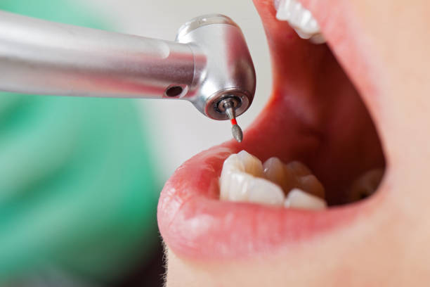 Best Chipped Tooth Repair Near Me  in East Foothills, CA